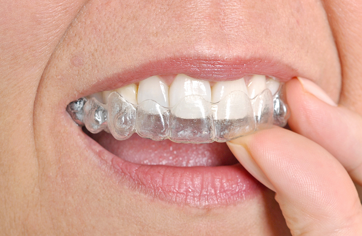 Am I a Candidate for Invisalign? Here’s What You Need to Know