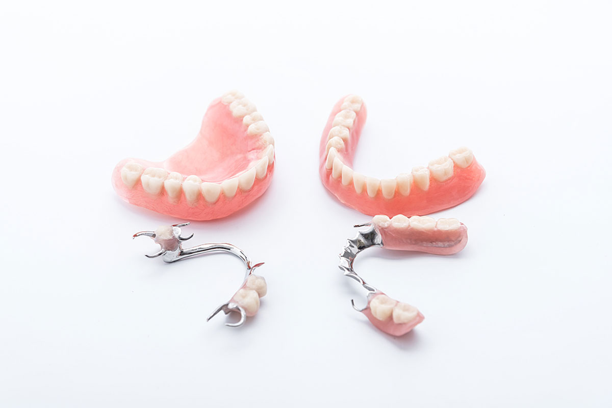 Unlocking A Lifetime of Smiles with Implants at Whittier Premier Dental